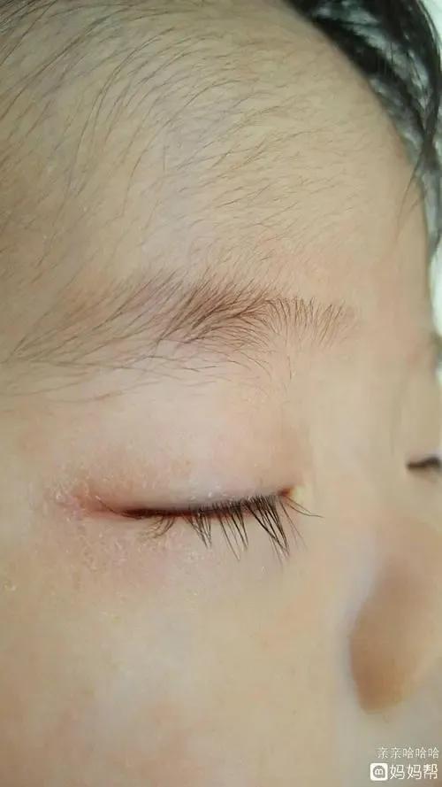 宝宝眼屎增多是怎么回事？
