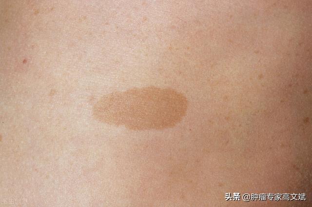 “牛奶斑”“泡泡宝贝”这些可能都是肿瘤的表现