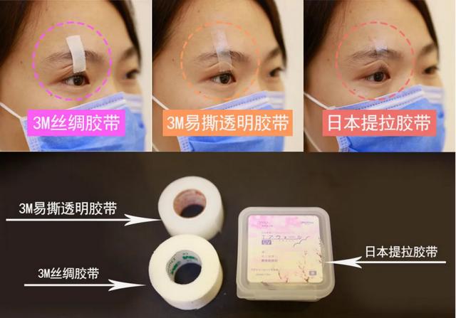 五年八部曲，上睑下垂分阶段治疗的故事