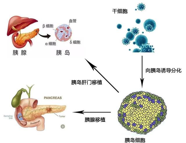 干细胞治疗：让“三高”不再可怕