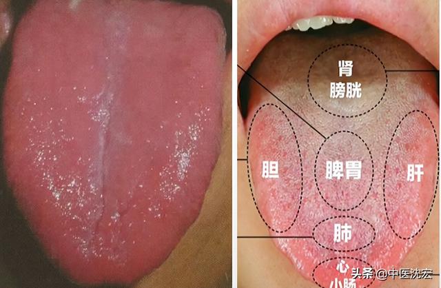舌头有裂纹，究竟是身体出了什么问题？今天沈医生一次给你讲明白