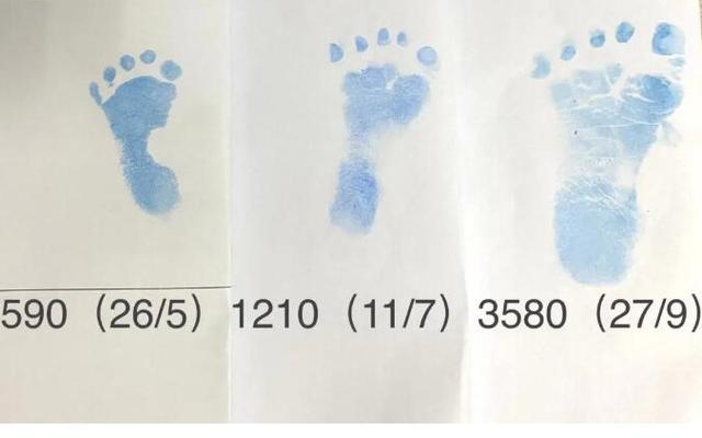 巴掌大超早产宝宝，152天“生命闯关”