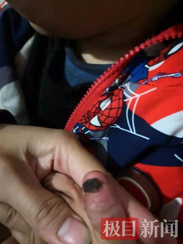 5岁姐姐好心办坏事，橡皮筋缠绕止血，2岁弟弟手指紫黑险截肢