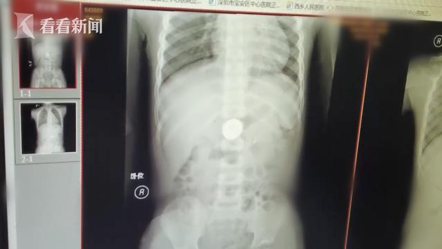 危险！6岁男童好奇吞硬币 卡在胃里一星期出不来