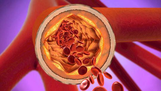 心脑血管事件在清晨高发，注意这7件事