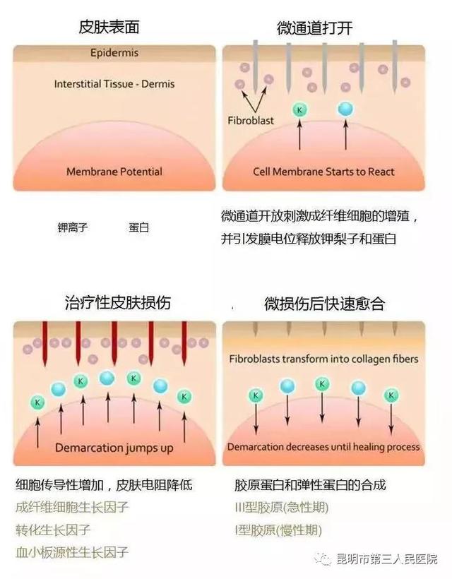 鸡皮肤去除医美