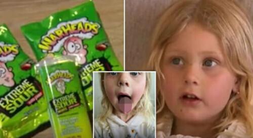 4岁女孩吃酸糖后舌头上被烧了个洞