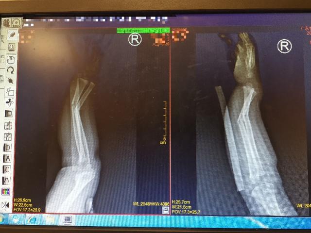 4龄童滑滑梯时意外骨折，纯手法复位20秒快速搞定