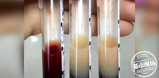 一晚连吃十盘肉，女子差点丢了命