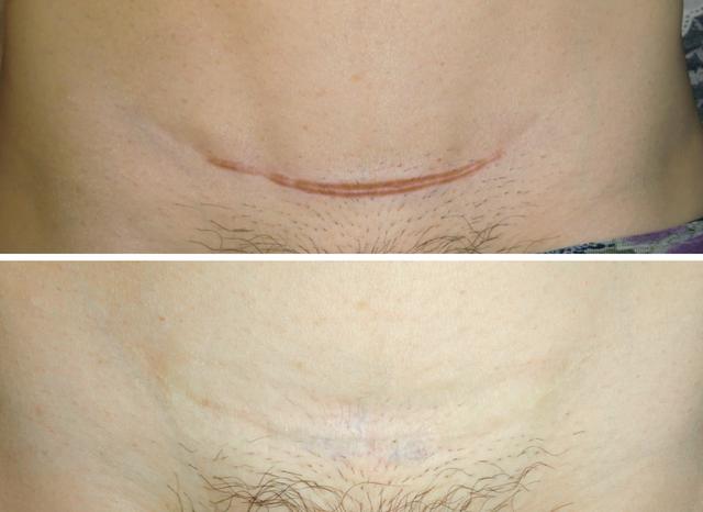 剖腹产留下的疤痕，你在意吗？来看看如何改善吧