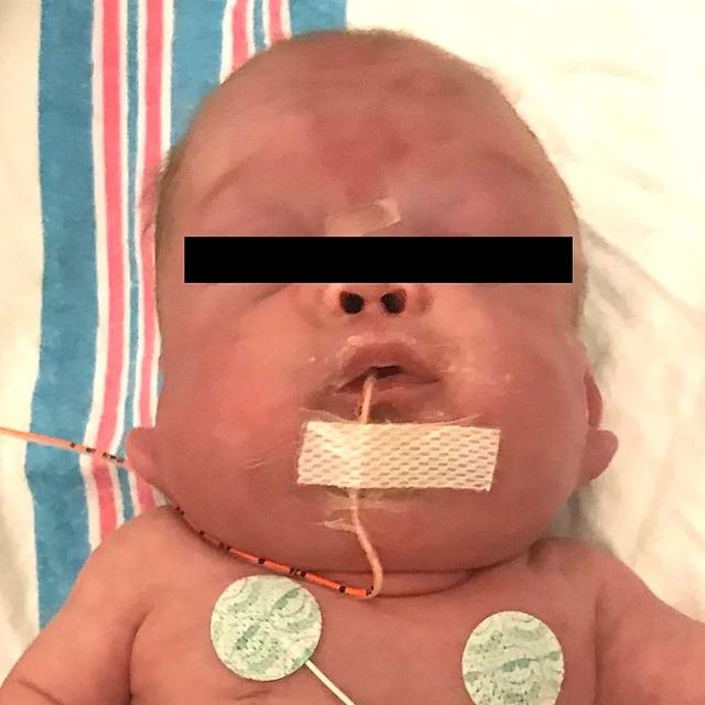 婴儿上腔静脉综合征