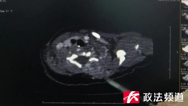 出生28天体重仅3.9公斤，婴儿确诊卡梅综合征！医生：孩子出现这些症状马上就医