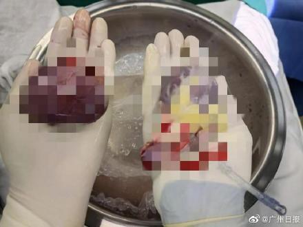 满月宝宝总是吐奶查出心脏病 广东医生为5月龄婴儿做心脏移植