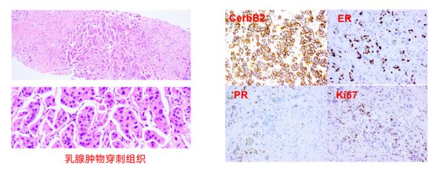 愈見未萊 | 恩美曲妥珠單抗精準助力HER2+乳腺癌患者的長期生存
