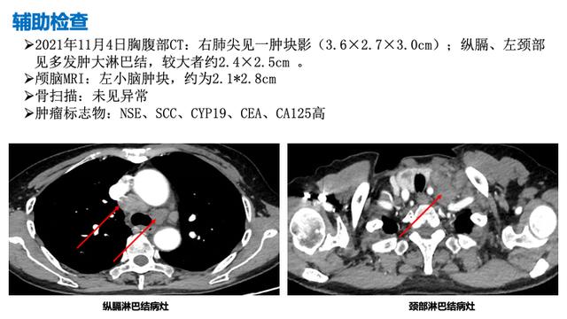 PPT檔案館｜一例國產三代TKI伏美替尼治療晚期肺腺癌的病例分享與思考