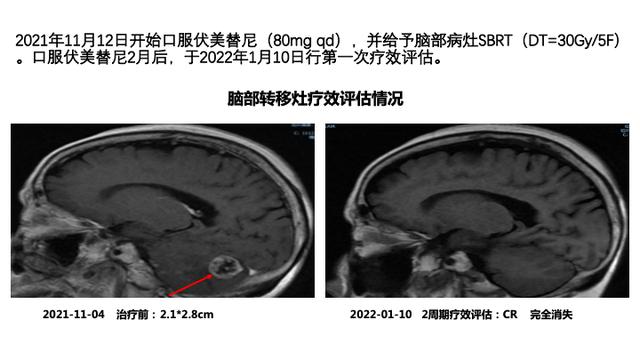 PPT檔案館｜一例國產三代TKI伏美替尼治療晚期肺腺癌的病例分享與思考