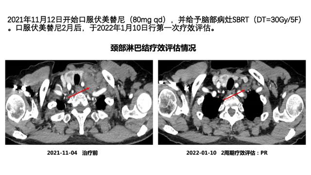 PPT檔案館｜一例國產三代TKI伏美替尼治療晚期肺腺癌的病例分享與思考