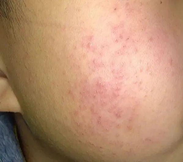 严重鸡皮肤如何缓解