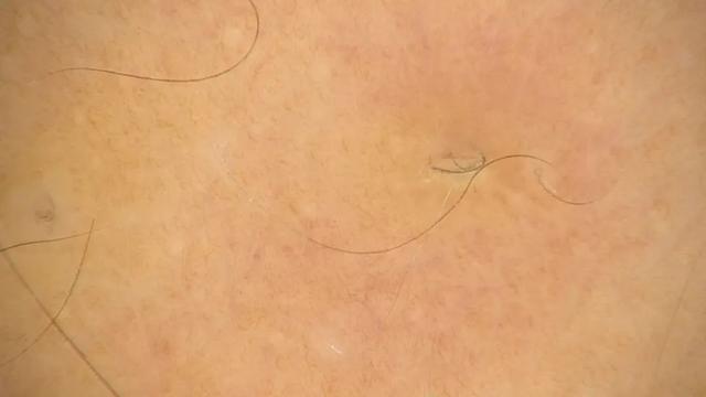 严重鸡皮肤如何缓解