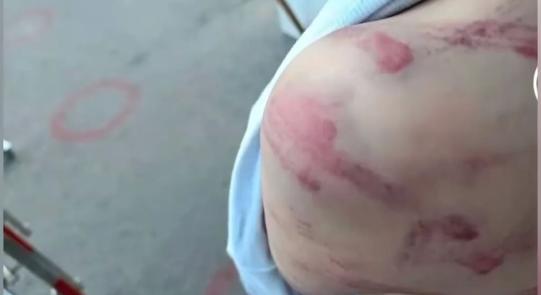 重庆一家长称小学生因做错2题被老师打伤，涉事教师已被停职立案