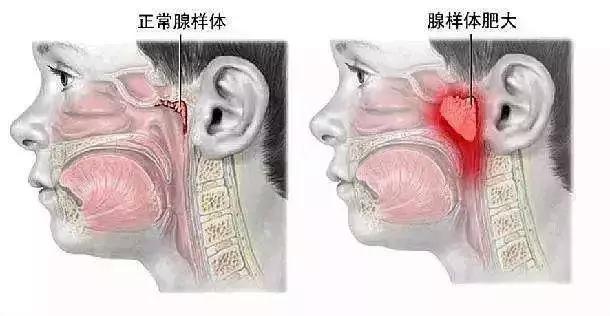 新生儿睡觉打呼噜正常吗，婴儿睡觉打呼噜正常吗（婴儿睡觉打呼可能是哪些方面的问题）