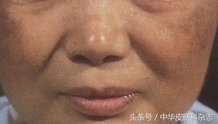 黄褐斑的药物治疗进展