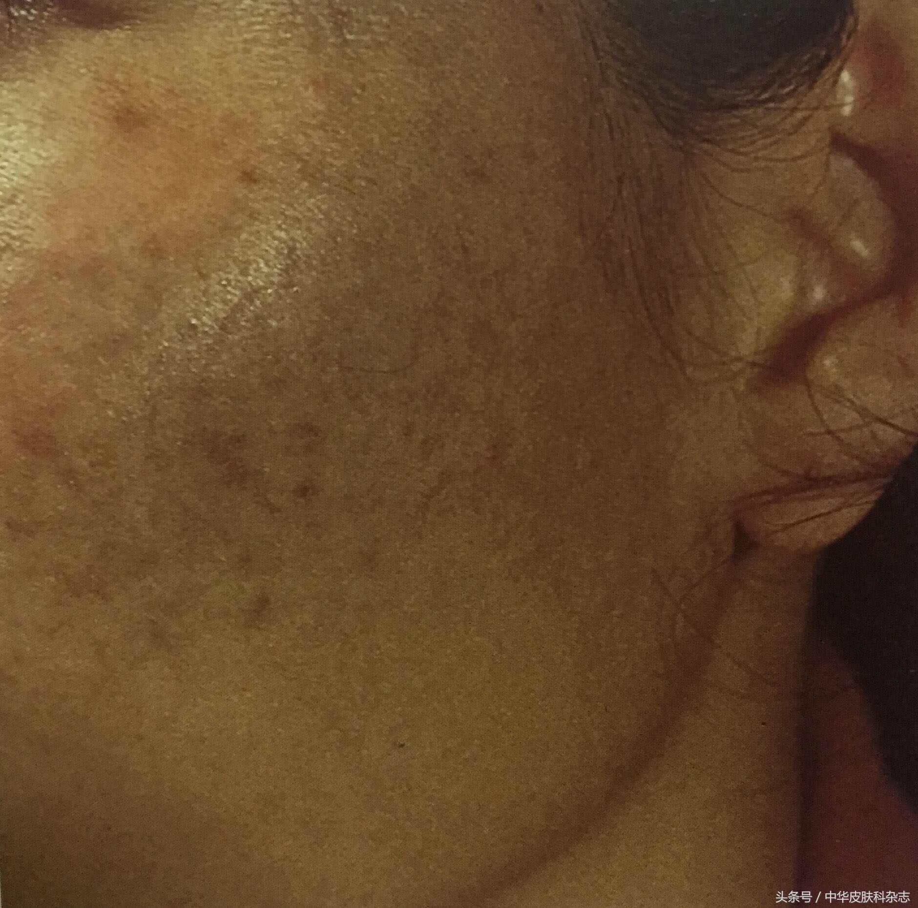 黄褐斑的药物治疗进展