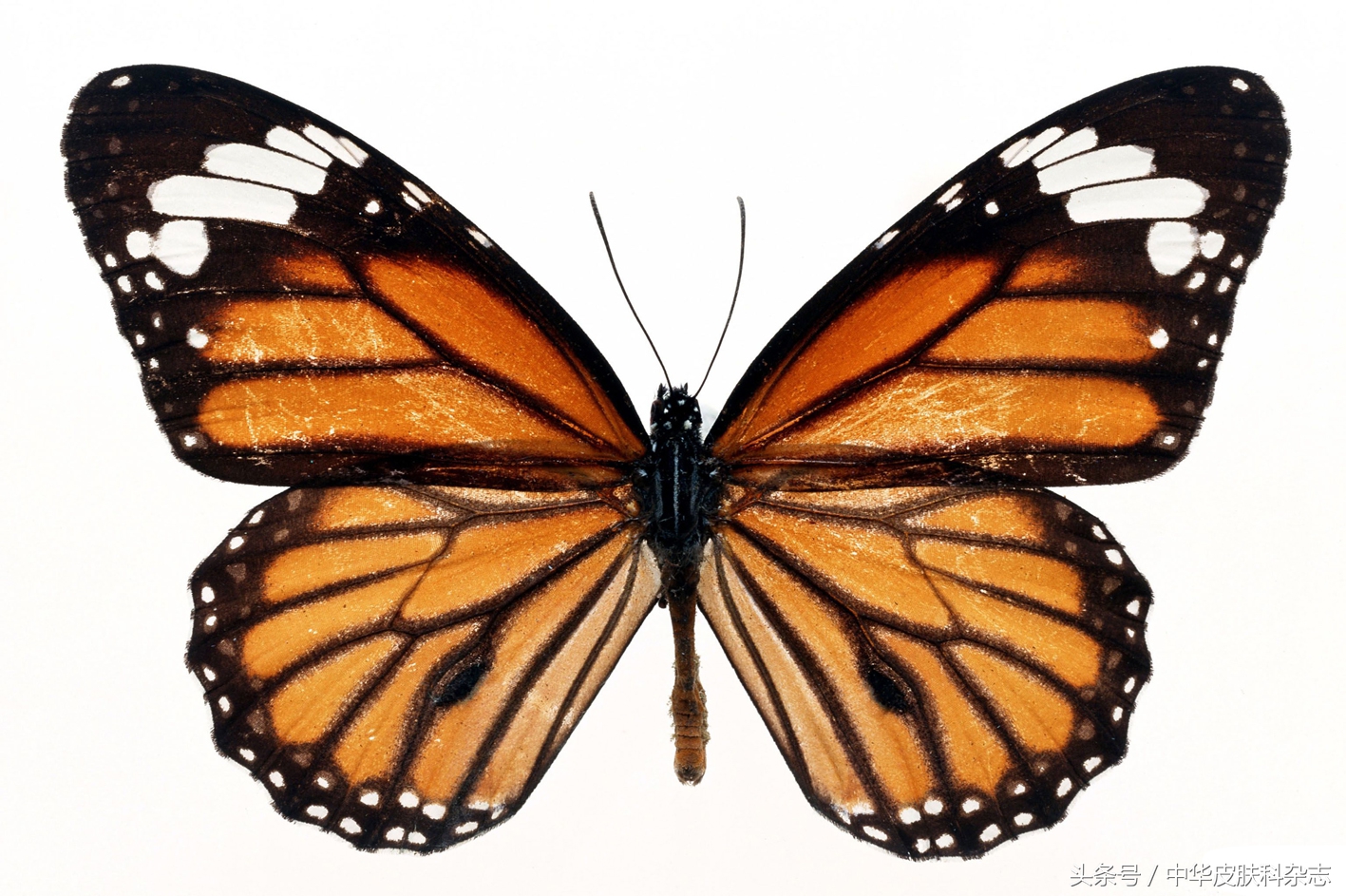 黄褐斑的药物治疗进展