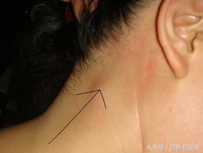 是淋巴结发炎吗?会变成恶性肿瘤吗?