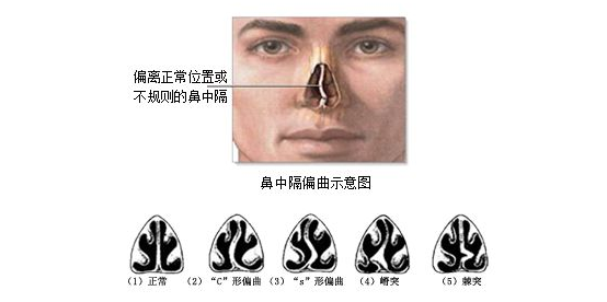 歪鼻大部分情况是由鼻中隔偏曲所造成的,鼻中隔偏曲从外形上会导致
