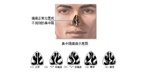 一个歪鼻伤4个器官，鼻子歪了该咋办？