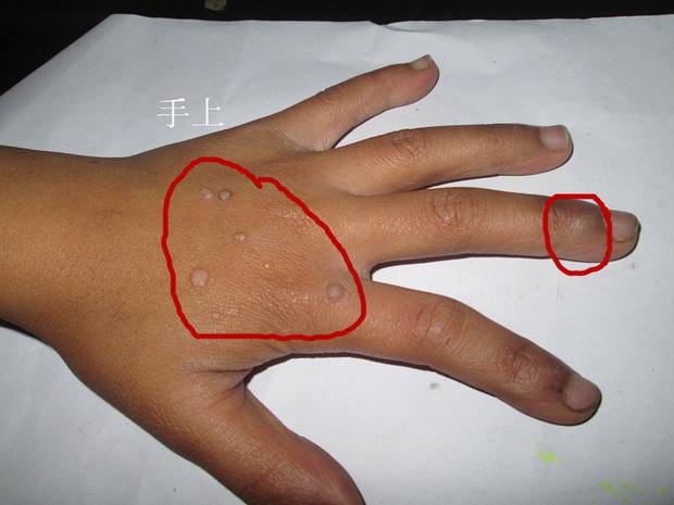 瘊子怎么治疗能除根(小心脸上手上的凸疣)