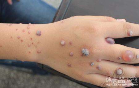 瘊子怎么治疗能除根(小心脸上手上的凸疣)