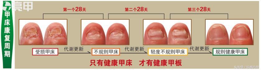 治疗灰指甲为什么很长时间还不能康复？