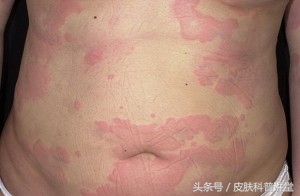 3~5分钟内如何让医生真正了解你的病情？皮肤科就医指南