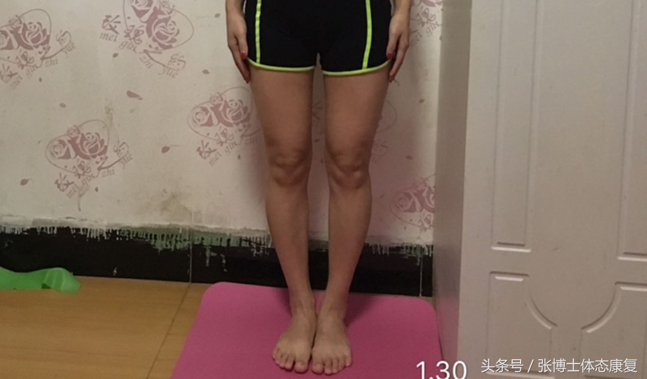 O型腿矫正方法有哪些？专业体态康复指导