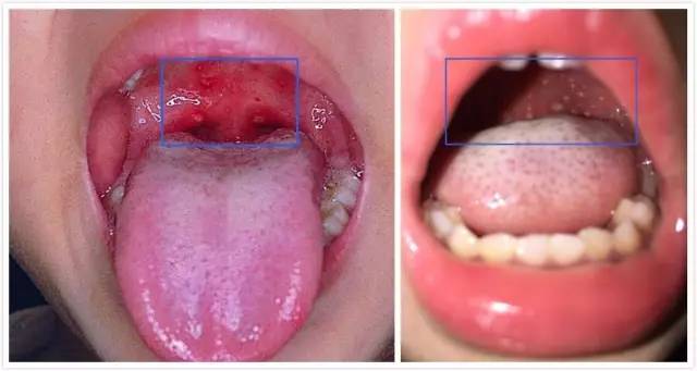 疱疹性咽颊炎高峰期到来，80%的幼儿可能中招，这种办法让孩子平安度过