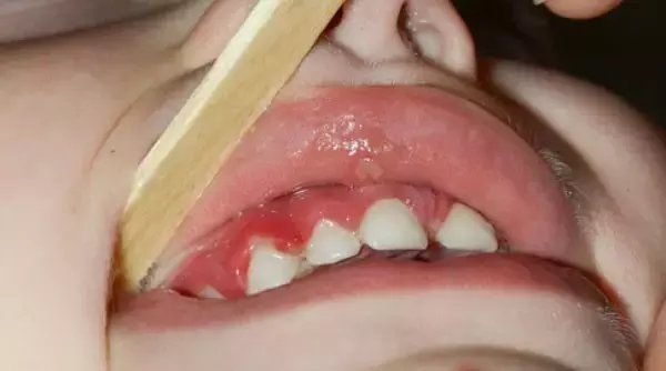 疱疹位置不同疱疹性咽峡炎只有口腔内有疱疹.
