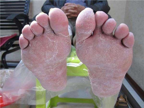 发白湿软,也可出现糜烂或皮肤增厚,粗糙,开裂,并可蔓延至足跖及边缘