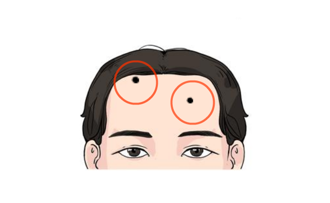 额头有痣