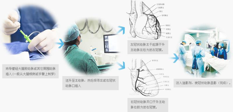 排除心脏病，为什么医生建议做冠脉造影而不是心脏CT？（一）