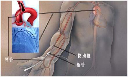 排除心脏病，为什么医生建议做冠脉造影而不是心脏CT？（一）