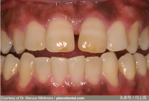 真图解析：牙龈不健康可能是因为这12种疾病和药物