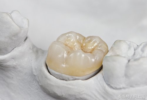它们被镶在牙齿上,过去常使用金子制作嵌体