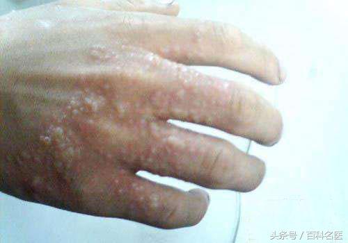 手上出现许多小水疱，奇痒，手癣？湿疹？还是汗疱疹？该怎么办？