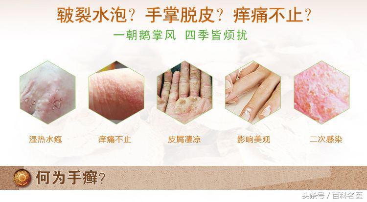手上出现许多小水疱，奇痒，手癣？湿疹？还是汗疱疹？该怎么办？