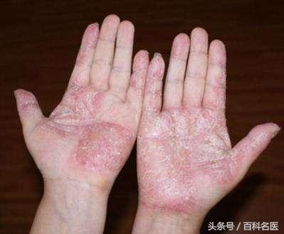 手上出现许多小水疱，奇痒，手癣？湿疹？还是汗疱疹？该怎么办？