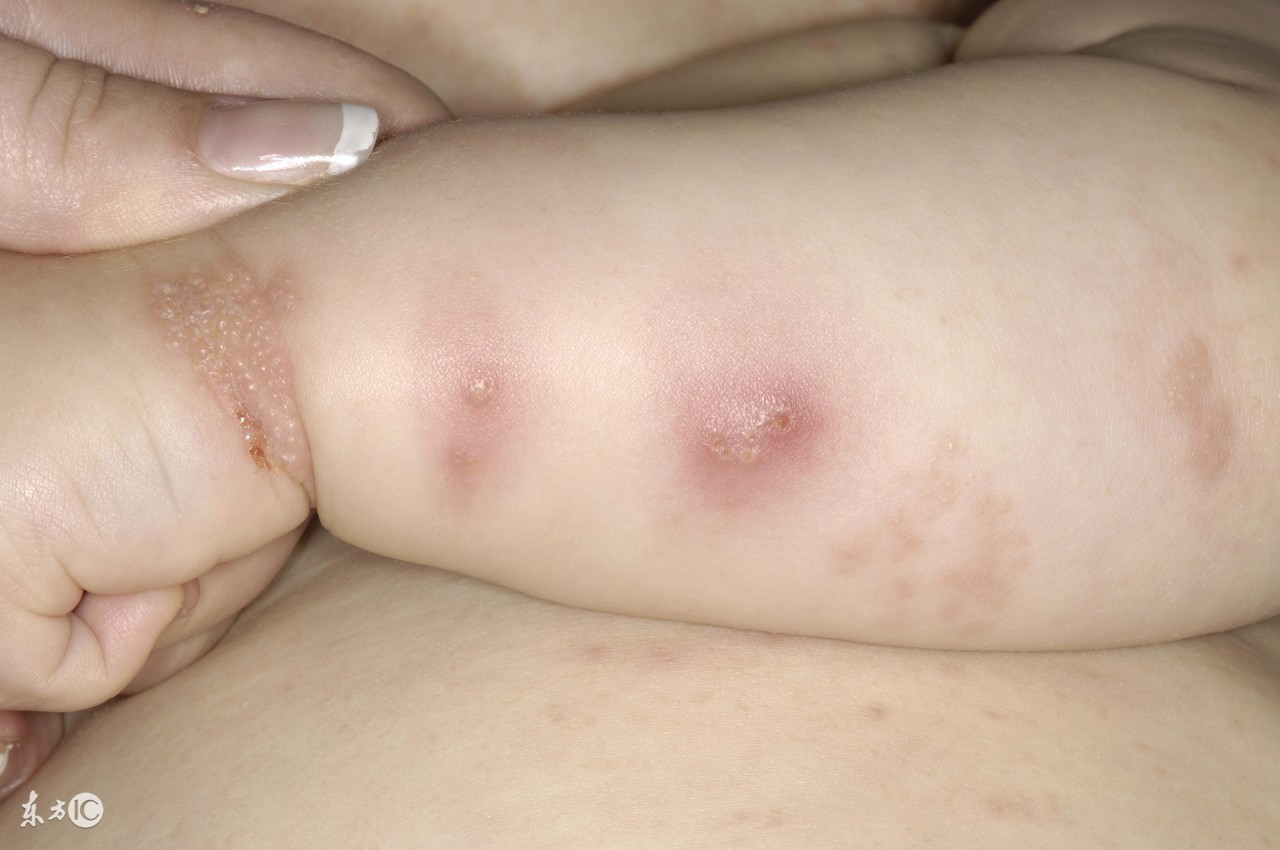 宝宝起疱疹的症状图片图片