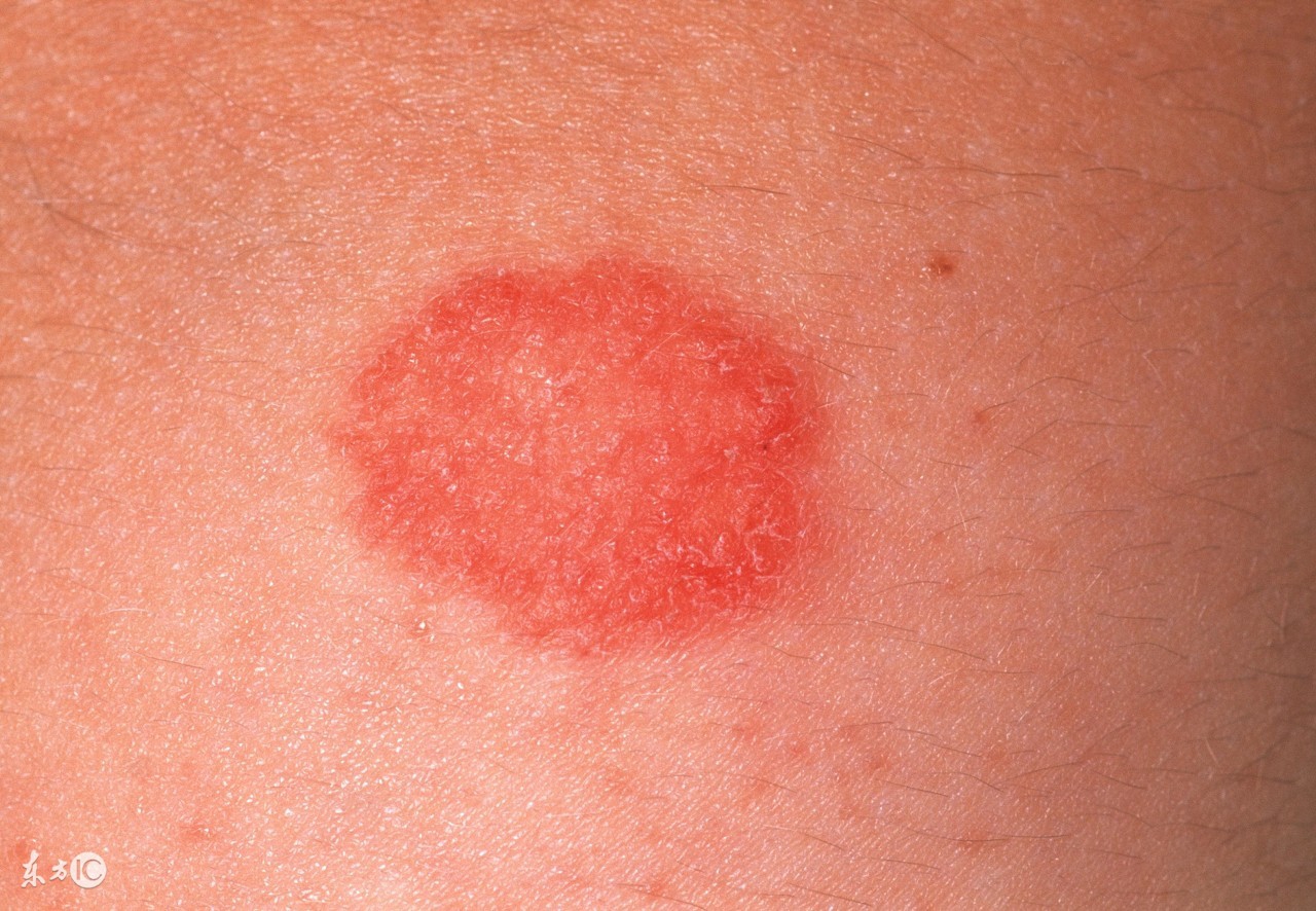 肝炎患者感染海洋创伤弧菌可致死亡