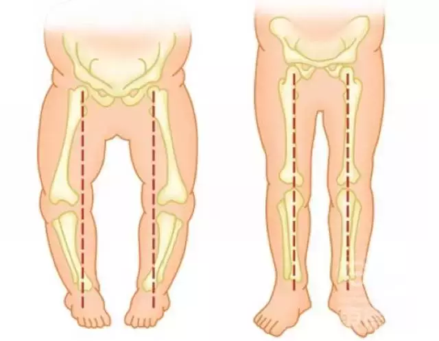 婴儿内八字脚怎么矫正（宝宝走路内八字）